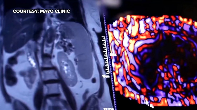 Healthy SA: Battling liver cancer, a disease which often has no symptoms early on — KENS 5 (San Antonio), Larimore Health news